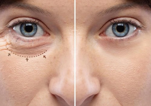 I vantaggi di un contorno occhi con un effetto lifting immediato per ringiovanire la pelle cascante intorno agli occhi
