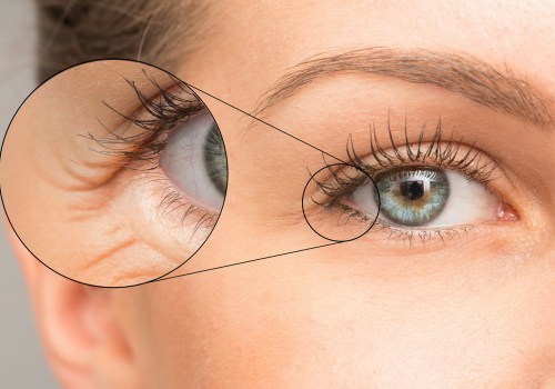 I vantaggi di un effetto lifting immediato per ridurre il rossore intorno agli occhi